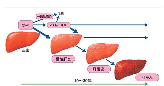 深圳肝炎治疗的五大禁忌